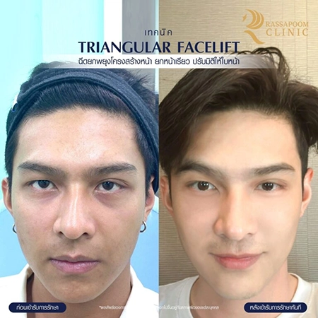 Filler injection (Triangular Face Lift)