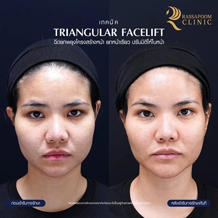 Filler injection (Triangular Face Lift)
