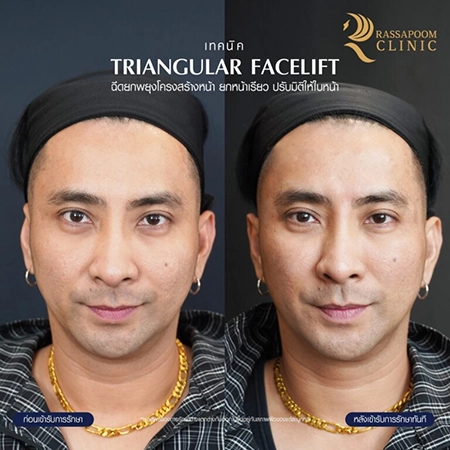 Filler injection (Triangular Face Lift)