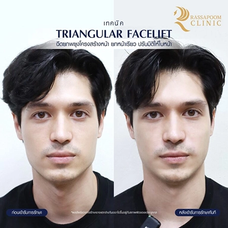 Filler injection (Triangular Face Lift)