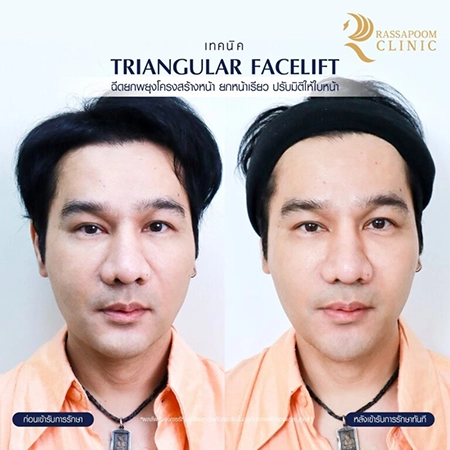 Filler injection (Triangular Face Lift)