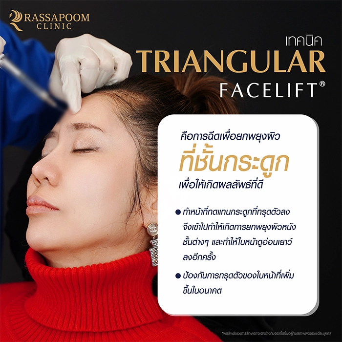 Filler injection (Triangular Face Lift)