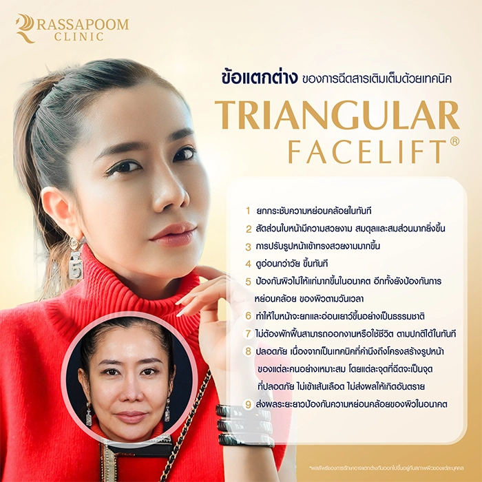 Filler injection (Triangular Face Lift)