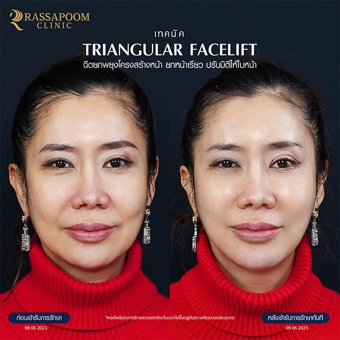 Filler injection (Triangular Face Lift)