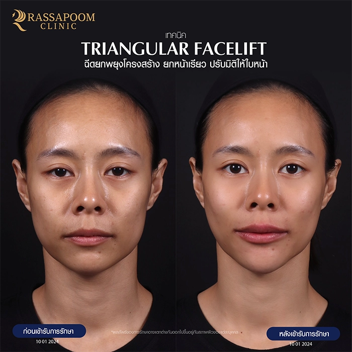 Filler injection (Triangular Face Lift)
