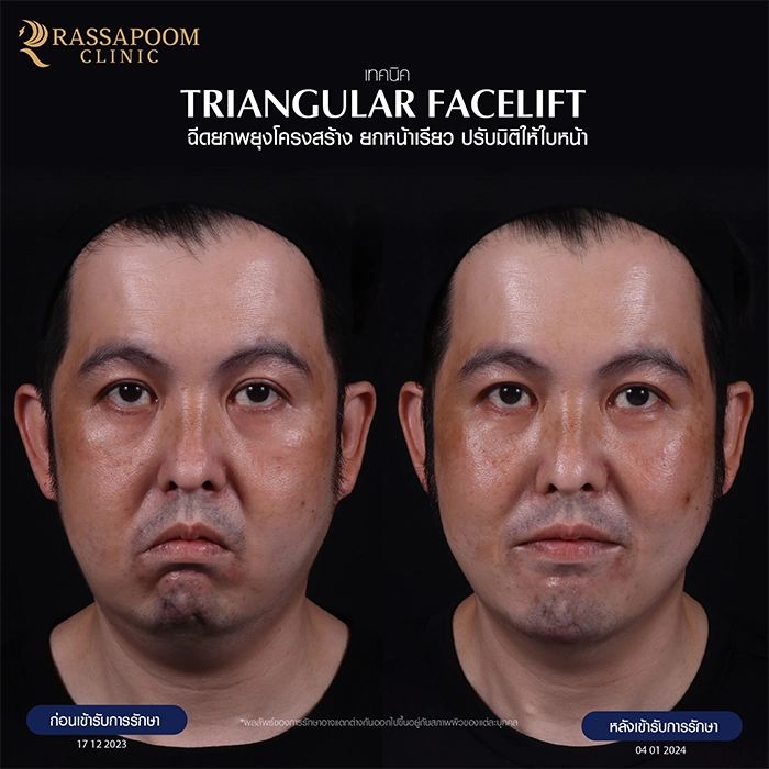 Filler injection (Triangular Face Lift)